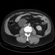 Pancreatic pseudocyst, pseudocyst in mesentery: CT - Computed tomography